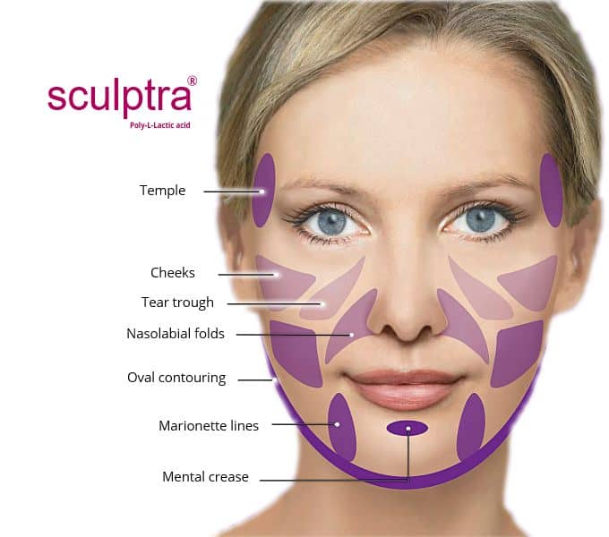 Sculptra